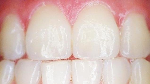 Close-up of teeth and gums