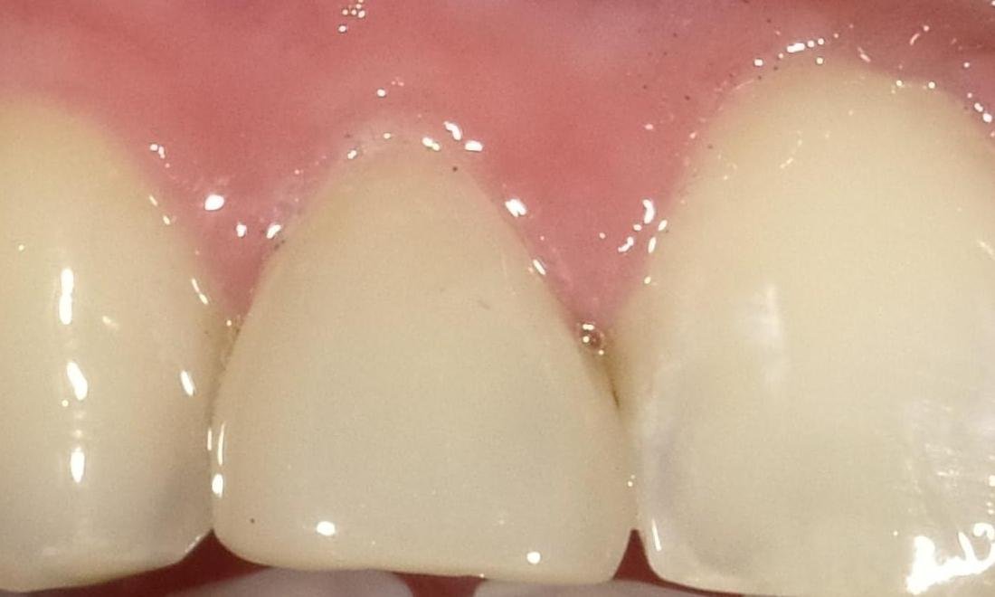 After anterior tooth bonding