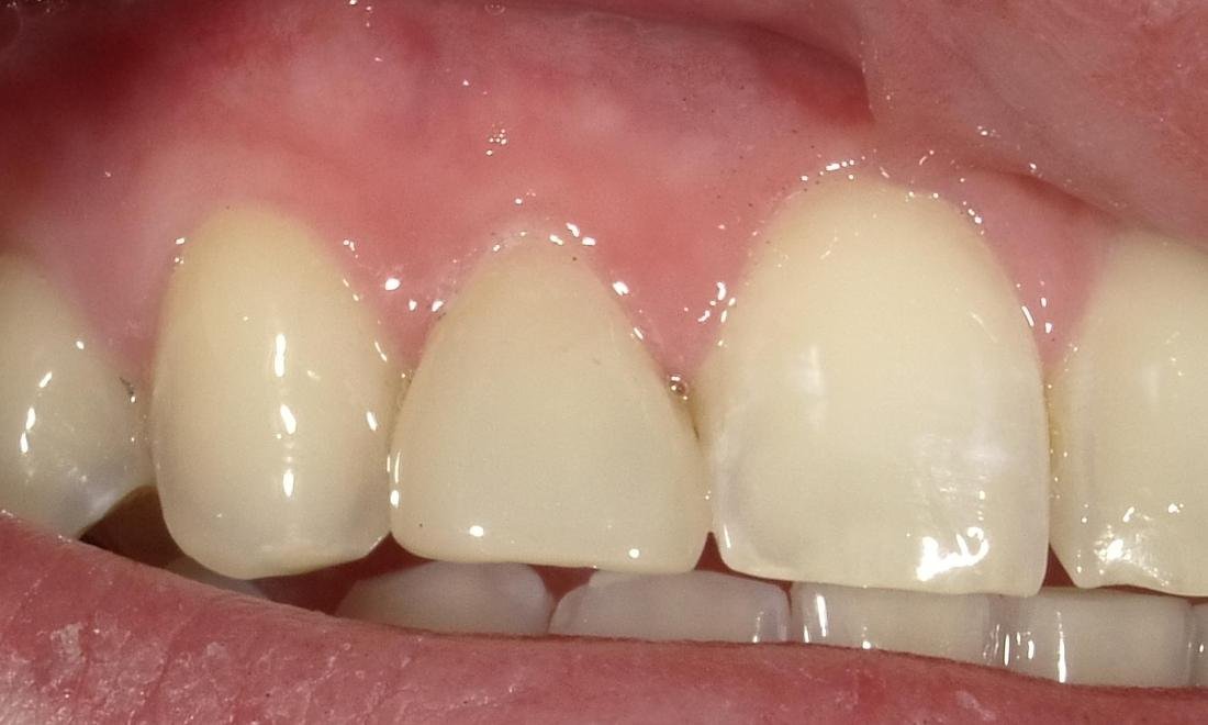After anterior tooth bonding, second case