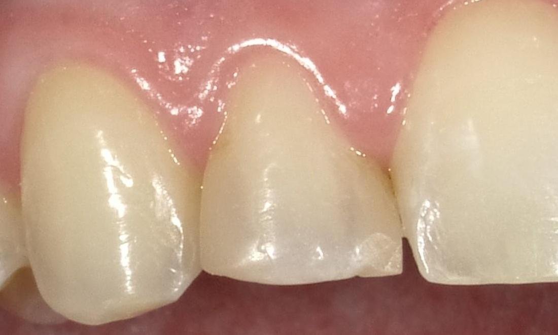 Before anterior tooth bonding