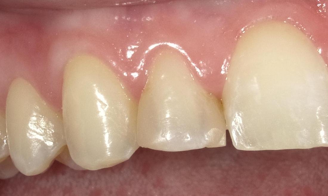 Before anterior tooth bonding, second case