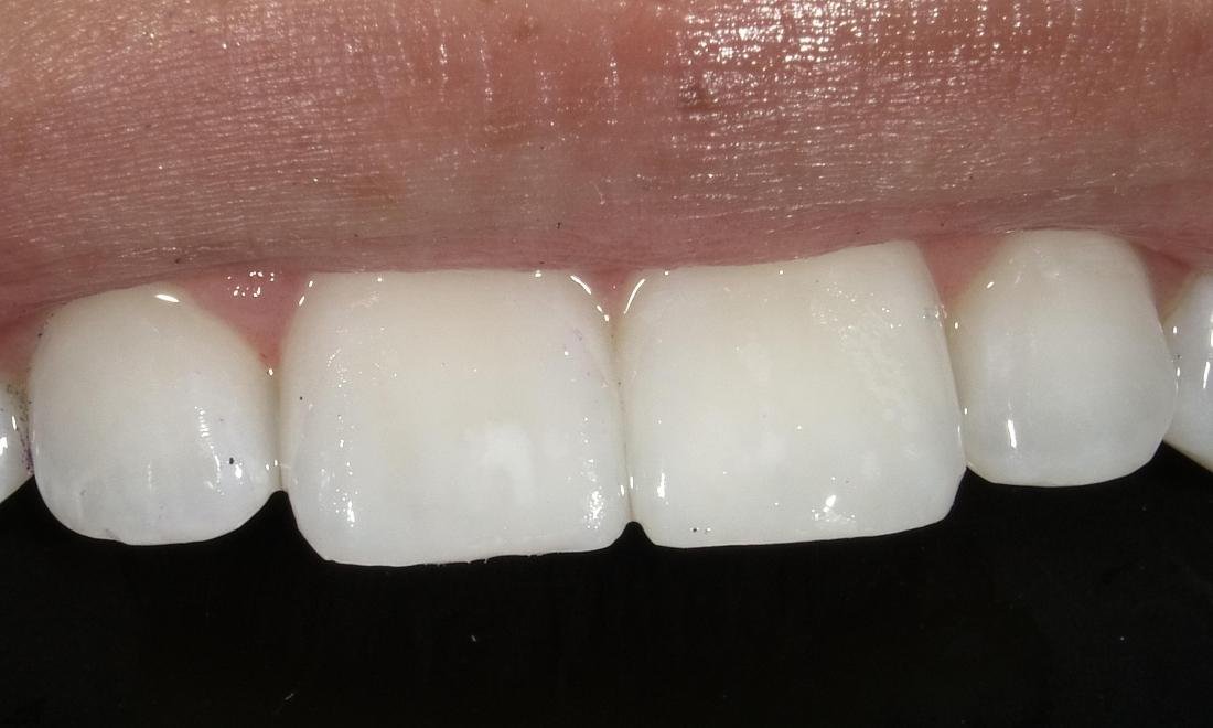 After resin infiltration treatment for white spots