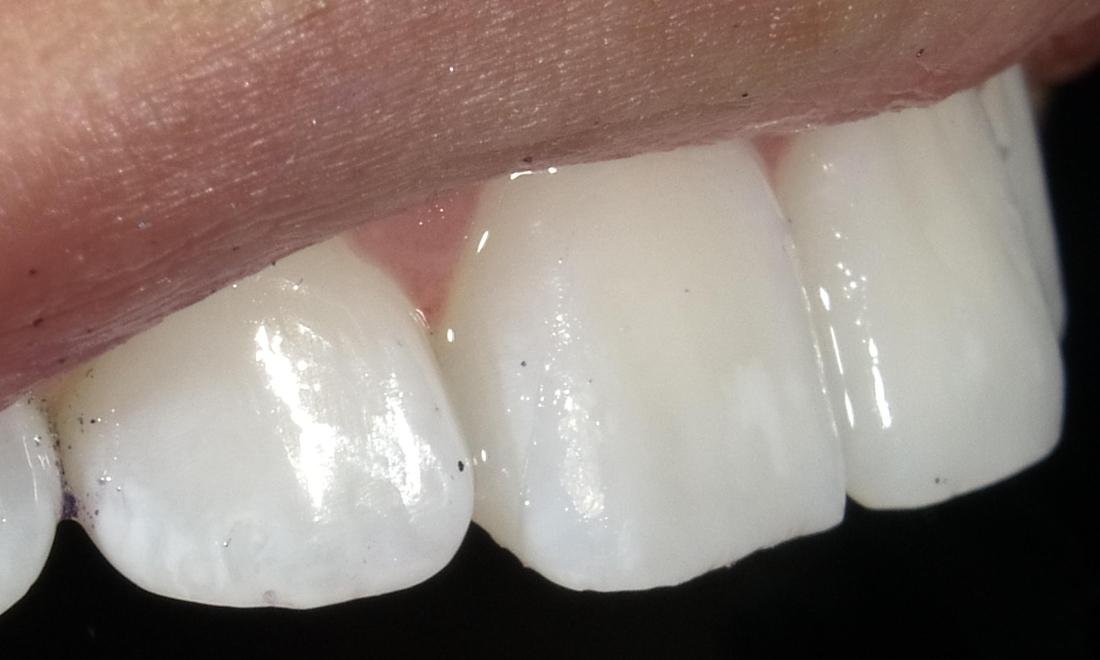 After resin infiltration treatment for white spots, second case