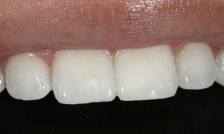 Resin-Infiltration-for-treatment-of-white-spots-After-Image
