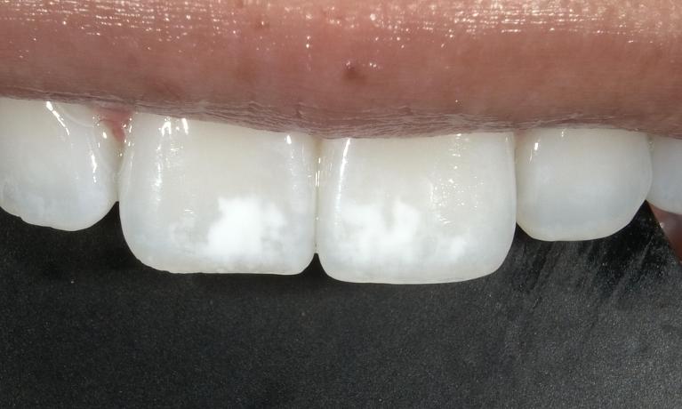 Resin-Infiltration-for-treatment-of-white-spots-Before-Image